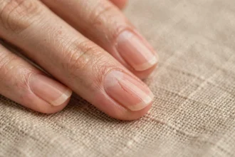 Gros plan d'un ongle fendu verticalement sur une main de femme posée sur un tissu de lin beige